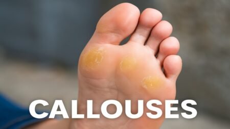 Callouses: Causes, Treatment, and Prevention Callouses