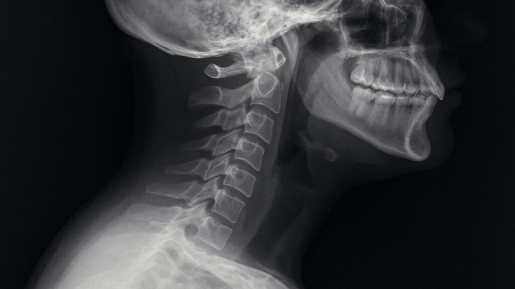 Cervical Lordosis – Understanding, Causes, Symptoms & Treatment Cervical Lordosis