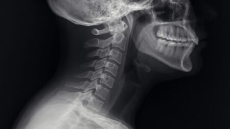 Cervical Lordosis – Understanding, Causes, Symptoms & Treatment Cervical Lordosis