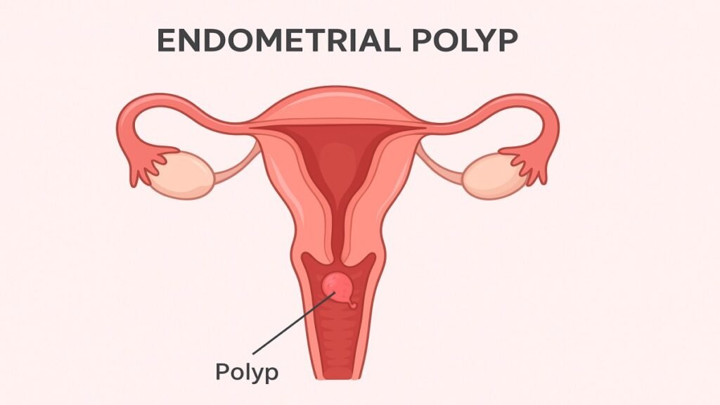 Endometrial Polyp: Causes, Symptoms, Diagnosis & Treatment Endometrial Polyp