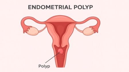 Endometrial Polyp: Causes, Symptoms, Diagnosis & Treatment Endometrial Polyp